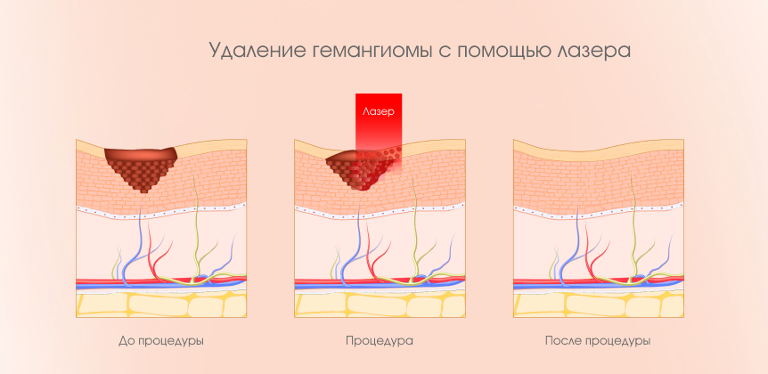 Удаление гемангиомы с помощью лазера