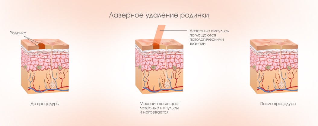 Лазерное удаление родинки