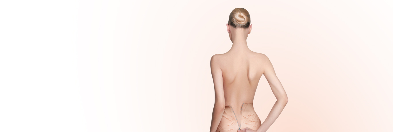 Лазерное удаление растяжек