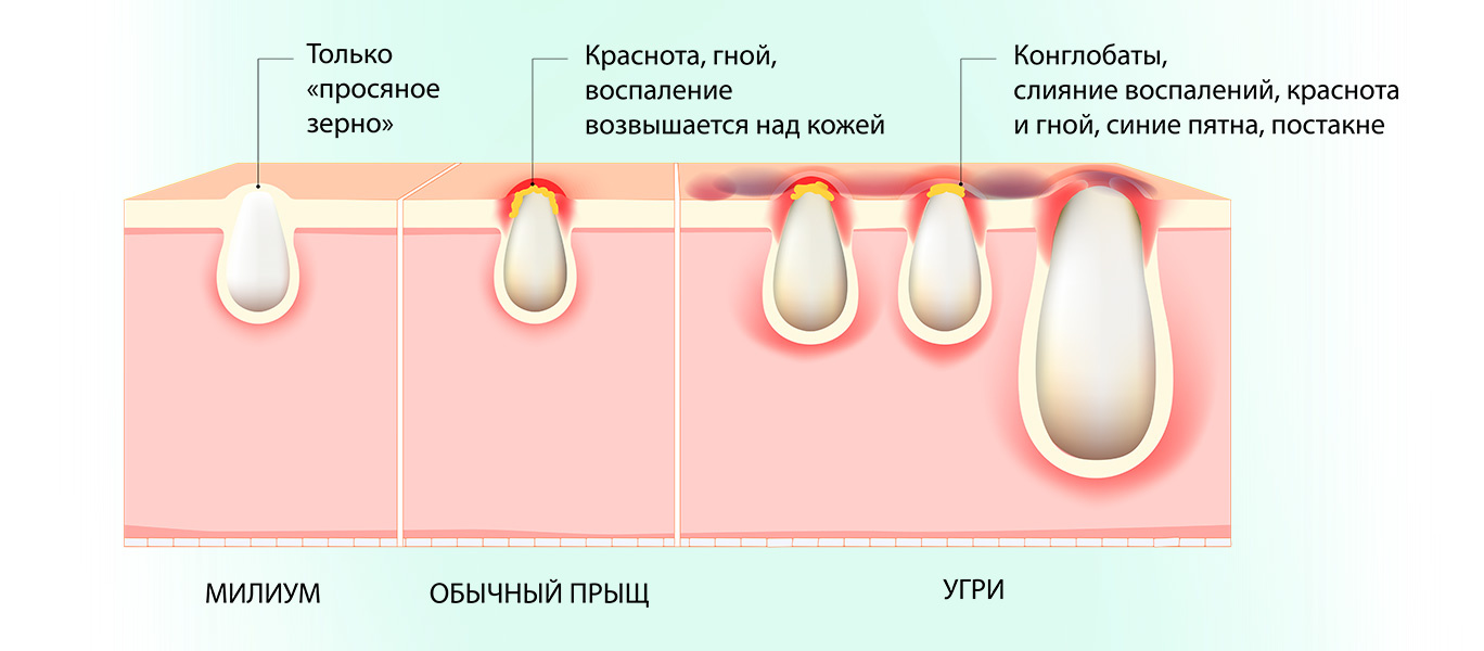 Что такое милиумы и как от них избавиться — блог медицинского центра ОН Клиник