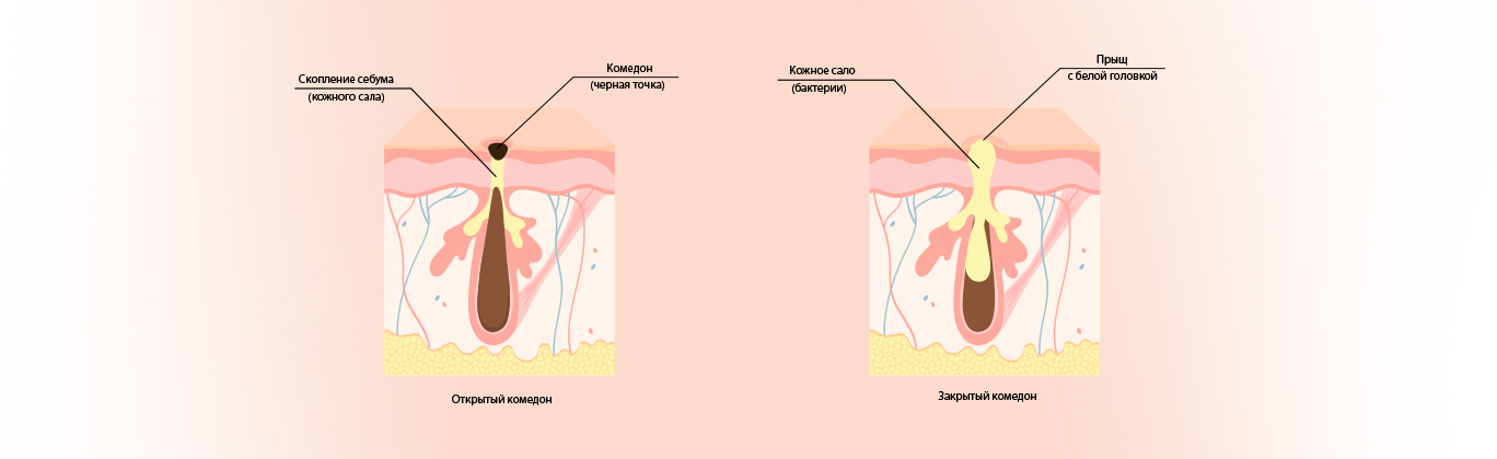 Как избавиться от закрытых комедонов?